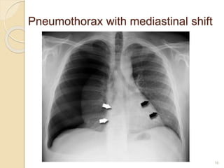 16
Pneumothorax with mediastinal shift
 