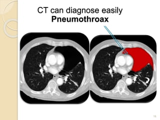 18
CT can diagnose easily
Pneumothroax
 