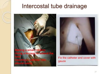 27
Intercostal tube drainage
Fix the catheter and cover with
gauze
Making a small incision
Using a forceps to extend the
hole
Inserting a catheter into
pleural cavity
 