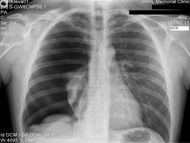 Pneumothorax & chest tube final year mbbs lecture