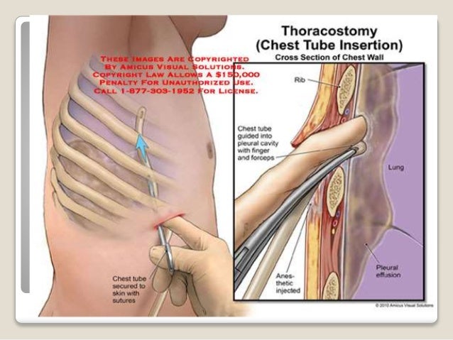 Pneumothorax Hemothorax