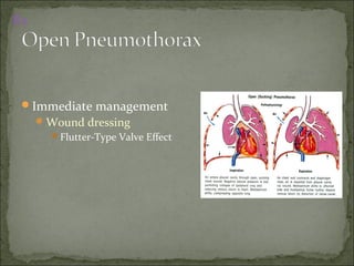 Immediate management
Wound dressing
Flutter-Type Valve Effect
Rx
 
