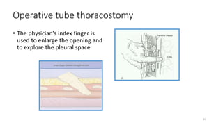 pneumothorax-cause-and-management-pptx