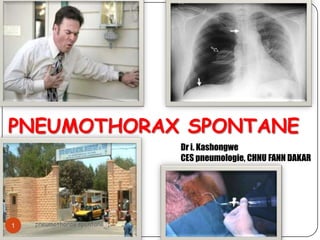 PNEUMOTHORAX SPONTANE
                            Dr i. Kashongwe
                            CES pneumologie, CHNU FANN DAKAR




1   pneumothorax spontané
 
