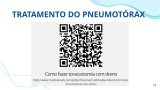 TRATAMENTO DO PNEUMOTÓRAX
13
 