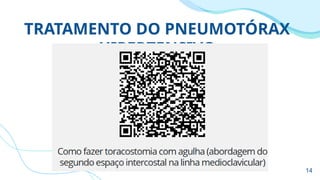 TRATAMENTO DO PNEUMOTÓRAX
HIPERTENSIVO
14
 