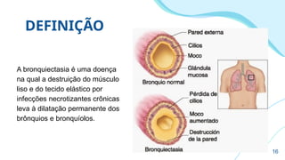 DEFINIÇÃO
A bronquiectasia é uma doença
na qual a destruição do músculo
liso e do tecido elástico por
infecções necrotizantes crônicas
leva à dilatação permanente dos
brônquios e bronquíolos.
16
 