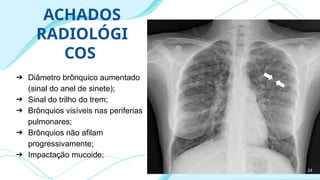 ACHADOS
RADIOLÓGI
COS
➔ Diâmetro brônquico aumentado
(sinal do anel de sinete);
➔ Sinal do trilho do trem;
➔ Brônquios visíveis nas periferias
pulmonares;
➔ Brônquios não afilam
progressivamente;
➔ Impactação mucoide;
24
 