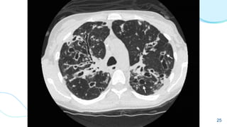 focal
afetando muitas áreas dos
pulmões
aparecendo em apenas 1 ou
2 áreas pulmonares
difusas
25
 