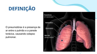 DEFINIÇÃO
O pneumotórax é a presença de
ar entre o pulmão e a parede
torácica, causando colapso
pulmonar.
3
 