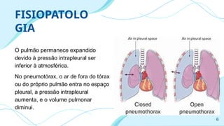 FISIOPATOLO
GIA
O pulmão permanece expandido
devido à pressão intrapleural ser
inferior à atmosférica.
No pneumotórax, o ar de fora do tórax
ou do próprio pulmão entra no espaço
pleural, a pressão intrapleural
aumenta, e o volume pulmonar
diminui.
6
 
