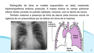 Radiografia de tórax (e modelo esquemático ao lado) mostrando
hipotransparência torácica avascular. A massa branca no campo pulmonar
inferior direito consiste no pulmão colabado, inclusive, com ar dentro da cisura.
Também notamos a presença da linha de pleura (esta torna-se visível na
vigência de um pneumotórax por se dobrar em torno de si mesma).
8
 