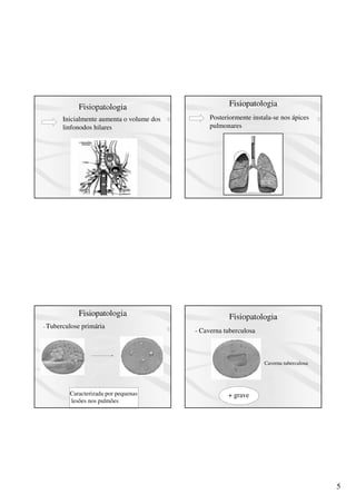 5
Fisiopatologia
Inicialmente aumenta o volume dos
linfonodos hilares
Fisiopatologia
Posteriormente instala-se nos ápices
pulmonares
Fisiopatologia
- Tuberculose primária
Caracterizada por pequenas
lesões nos pulmões
Fisiopatologia
Caverna tuberculosa
- Caverna tuberculosa
+ grave
 