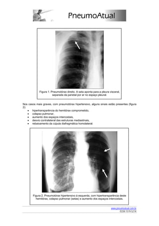 Figura 1. Pneumotórax direito. A seta aponta para a pleura visceral,
                        separada da parietal por ar no espaço pleural.


Nos casos mais graves, com pneumotórax hipertensivo, alguns sinais estão presentes (figura
2):
    • hipertransparência do hemitórax comprometido,
    • colapso pulmonar,
    • aumento dos espaços intercostais,
    • desvio contralateral das estruturas mediastinais,
    • rebaixamento da cúpula diafragmática homolateral.




        Figura 2. Pneumotórax hipertensivo à esquerda, com hipertransparência deste
          hemitórax, colapso pulmonar (setas) e aumento dos espaços intercostais.


                                                                         www.pneumoatual.com.br
                                                                                ISSN 1519-521X
 