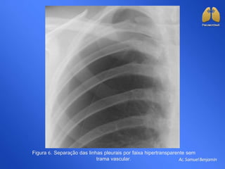 Figura 6. Separação das linhas pleurais por faixa hipertransparente sem
trama vascular.
 
