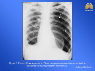 Figura 7. Pneumotórax à esquerda. Observe a ponta do coração e o mediastino
afastando-se do pneumotórax hipertensivo.
 