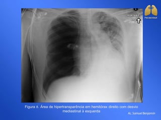 Figura 8. Área de hipertransparência em hemitórax direito com desvio
mediastinal à esquerda
 