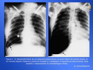 Figura 9. A, Desenvolvimento de um pequeno pneumotórax na parte inferior do pulmão direito. B,
(30 minutos depois) Observe a ponta do coração e o mediastino à esquerda do penumotórax. Note
também o rebaixamento do hemidiafragma direito.
 