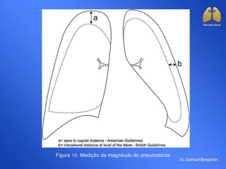 Figura 10. Medição da magnitude do pneumotórax
 