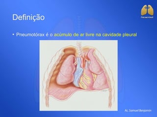 Definição
• Pneumotórax é o acúmulo de ar livre na cavidade pleural
 