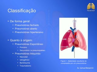 Classificação
• De forma geral:
• Pneumotórax fechado
• Pneumotórax aberto
• Pneumotórax hipertensivo
• Quanto à origem:
• Pneumotórax Espontâneo
• Primário
• Secundário (a pneumopatias)
• Pneumotórax Adquirido
• Neonatal
• Iatrogênico
• Barotrauma
• Traumatismo
Figura 1. Atelectasia resultante da
compressão por um pneumotórax
 