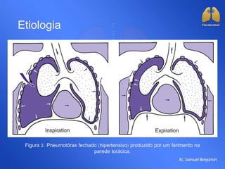 Etiologia
Figura 2. Pneumotórax fechado (hipertensivo) produzido por um ferimento na
parede torácica.
 
