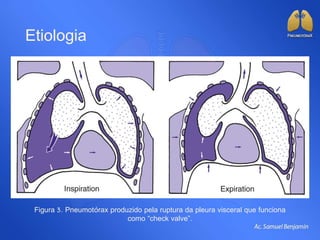 Etiologia
Figura 3. Pneumotórax produzido pela ruptura da pleura visceral que funciona
como “check valve”.
 