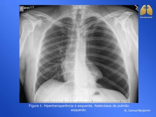 Figura 5. Hipertransparência à esquerda. Atelectasia de pulmão
esquerdo.
 