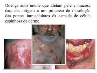 Doença auto imune que afetam pele e mucosa
daquelas origem a um processo de dissolução
das pontes intracelulares da camada de célula
espinhosa da derme.
 