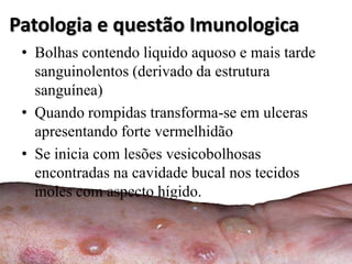 Patologia e questão Imunologica
 • Bolhas contendo liquido aquoso e mais tarde
   sanguinolentos (derivado da estrutura
   sanguínea)
 • Quando rompidas transforma-se em ulceras
   apresentando forte vermelhidão
 • Se inicia com lesões vesicobolhosas
   encontradas na cavidade bucal nos tecidos
   moles com aspecto hígido.
 