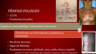 PÉNFIGO FOLIÁCEO 
• 13.7% 
• Predomina en judíos 
Empieza como pénfigo o dermatitis seborreica 
Transforma en eritrodermia exfoliativa y 
rezumante 
• No afecta mucosas 
• Signo de Nikolsky 
• Predomina en cuero cabelludo, cara, cuello, tórax y espalda 
Guzmán, R. A. (2013). Dermatología: Atlas, diagnóstico y tratamiento . México, DF: McGraw Hill . 
 