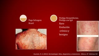 Fogo Selvagem 
Brasil 
Pénfigo Herpetiforme, 
Pénfigo con IgA 
Raro 
Evolución 
crónica y 
benigna 
Guzmán, R. A. (2013). Dermatología: Atlas, diagnóstico y tratamiento . México, DF: McGraw Hill . 
 
