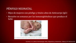 PÉNFIGO NEONATAL 
• Hijos de mujeres con pénfigo y titulos altos de Anticuerpo IgG1 
• Resuelve en semanas por las inmunoglobulinas que produce el 
bebe 
Guzmán, R. A. (2013). Dermatología: Atlas, diagnóstico y tratamiento . México, DF: McGraw Hill . 
 