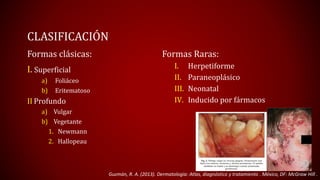 CLASIFICACIÓN 
Formas clásicas: 
I. Superficial 
a) Foliáceo 
b) Eritematoso 
II Profundo 
a) Vulgar 
b) Vegetante 
1. Newmann 
2. Hallopeau 
Formas Raras: 
I. Herpetiforme 
II. Paraneoplásico 
III. Neonatal 
IV. Inducido por fármacos 
Guzmán, R. A. (2013). Dermatología: Atlas, diagnóstico y tratamiento . México, DF: McGraw Hill . 
 
