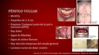 PÉNFIGO VULGAR 
• 80-85% 
• Ampollas de 1-2 cm 
• Empieza: Cualquier parte de la piel o 
mucosas (60%) 
• Hay dolor 
• Signo de Nikolsky 
• Signo de Asboe-Hansen 
• Hay afección temprana del estado general 
• Lesiones curan sin dejar cicatriz 
Guzmán, R. A. (2013). Dermatología: Atlas, diagnóstico y tratamiento . México, DF: McGraw Hill . 
 