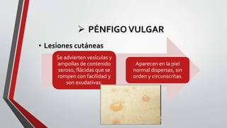  PÉNFIGOVULGAR
Se advierten vesículas y
ampollas de contenido
seroso, flácidas que se
rompen con facilidad y
son exudativas.
Aparecen en la piel
normal dispersas, sin
orden y circunscritas.
• Lesiones cutáneas
 