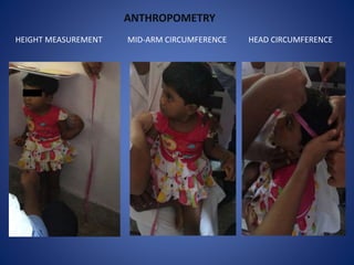 MID-ARM CIRCUMFERENCE HEAD CIRCUMFERENCEHEIGHT MEASUREMENT
ANTHROPOMETRY
 