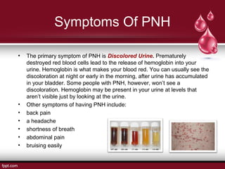 Paroxysmal Nocturnal Hemoglobinuria Urine