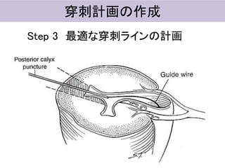 穿刺計画の作成
Step 3 最適な穿刺ラインの計画
 