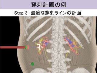穿刺計画の例
Step 3 最適な穿刺ラインの計画
 