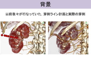 背景
以前我々が行なっていた，穿刺ライン計画と実際の穿刺
 