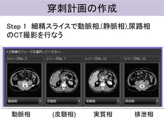 穿刺計画の作成
Step 1 細精スライスで動脈相,(静脈相),尿路相
のCT撮影を行なう
動脈相 (皮髄相) 実質相 排泄相
 