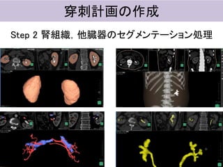 穿刺計画の作成
Step 2 腎組織，他臓器のセグメンテーション処理
 