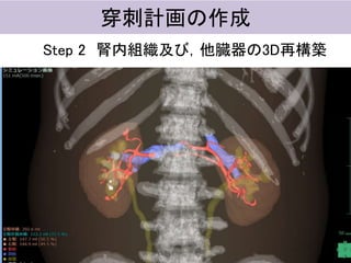 穿刺計画の作成
Step 2 腎内組織及び，他臓器の3D再構築
 