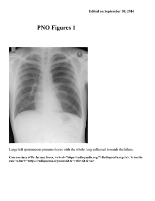 Edited on September 30, 2016
PNO Figures 1
Large left spontaneous pneumothorax with the whole lung collapsed towards the hilum.
Case courtesy of Dr Jeremy Jones, <a href="https://radiopaedia.org/">Radiopaedia.org</a>. From the
case <a href="https://radiopaedia.org/cases/6122">rID: 6122</a>
 