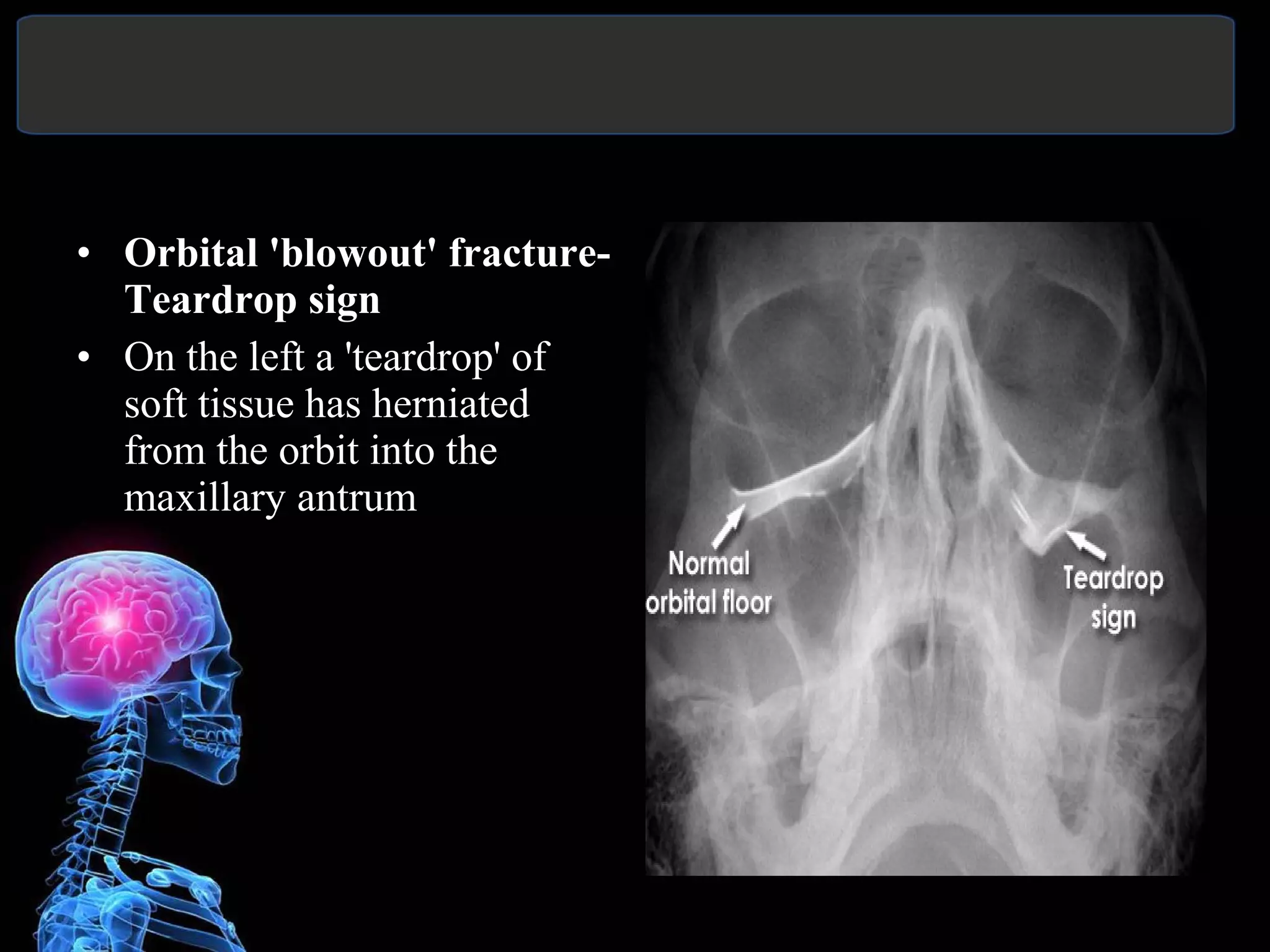 Tear Sign Pns view | PPT
