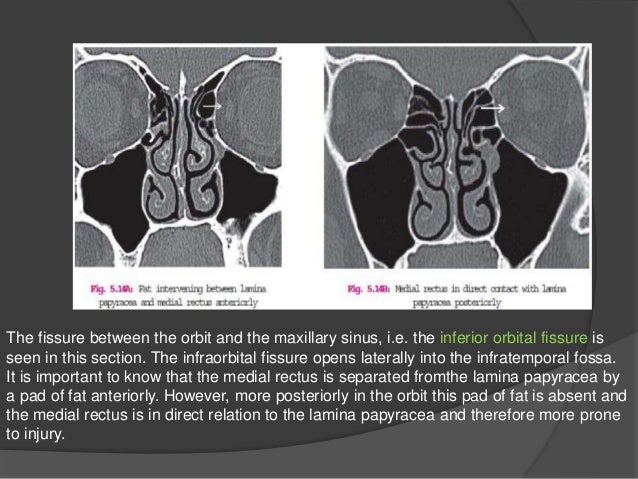 PNS (Para-nasal-sinuses) anatomy and variants