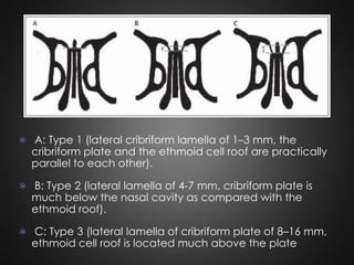  A: Type 1 (lateral cribriform lamella of 1–3 mm, the

cribriform plate and the ethmoid cell roof are practically
parallel to each other).

 B: Type 2 (lateral lamella of 4-7 mm, cribriform plate is

much below the nasal cavity as compared with the
ethmoid roof).

 C: Type 3 (lateral lamella of cribriform plate of 8–16 mm,

ethmoid cell roof is located much above the plate

 
