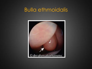 Bulla ethmoidalis

 