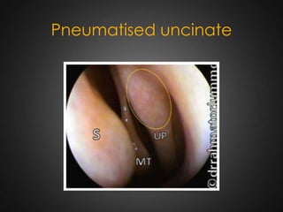 Pneumatised uncinate

 